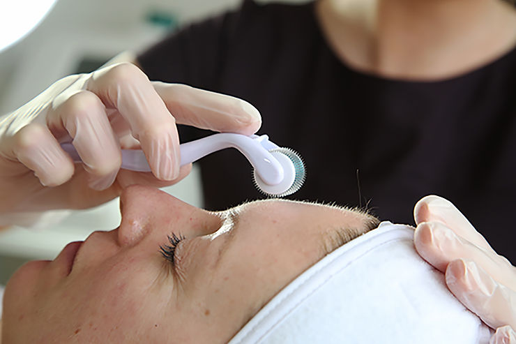 What microneedling looks like